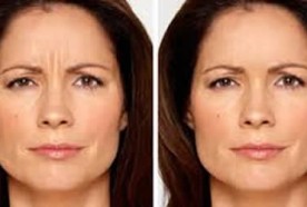 skin tightening, laser resurfacing, cosmetic procedures, chemical peels