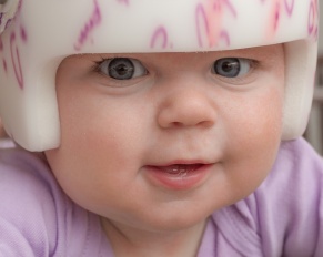 baby plagiocephaly helmet