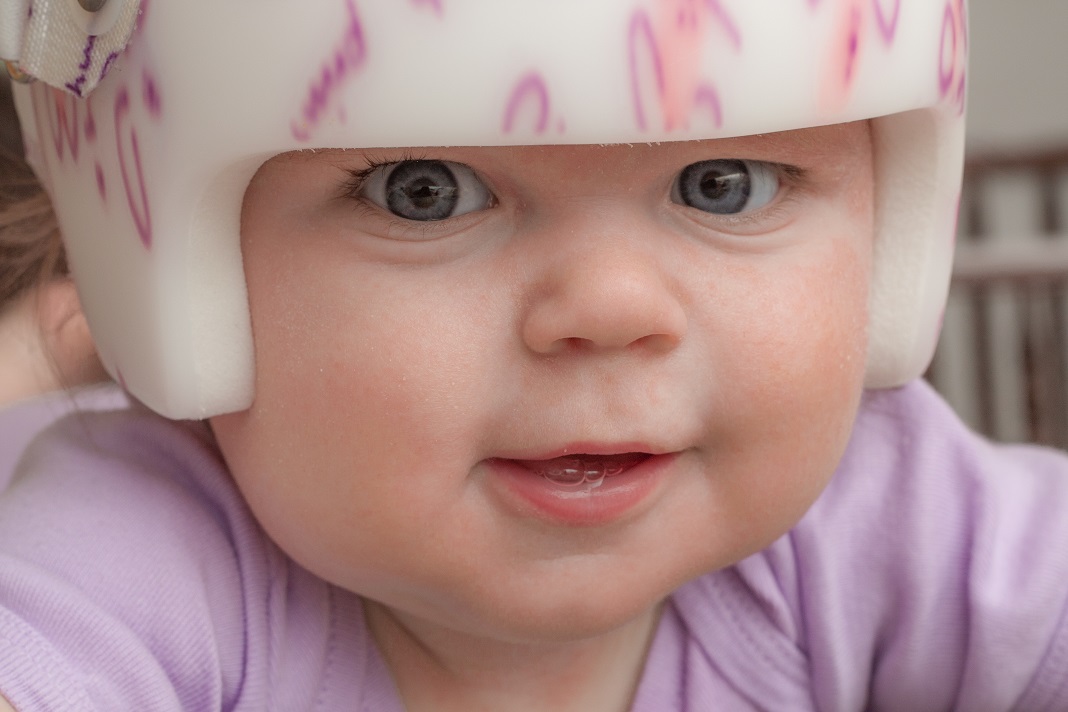 baby plagiocephaly helmet