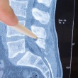 spinal stenosis