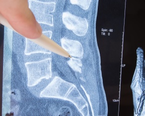 spinal stenosis