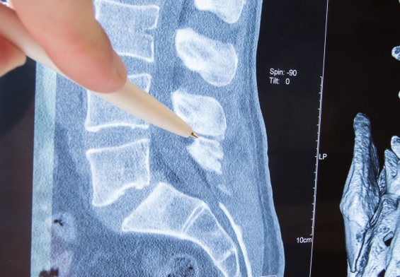 spinal stenosis